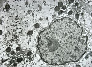 F,1y. | glycogenosis type II. (glycogen dissolved due to UA blockstaining)